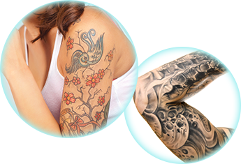 Tattoo Removal in Sun City West, AZ | 20% Off Tattoo Removal Service
