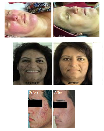IPL Before & After IPL Before & After