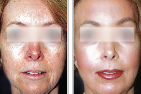 Laser Skin Rejuvenation